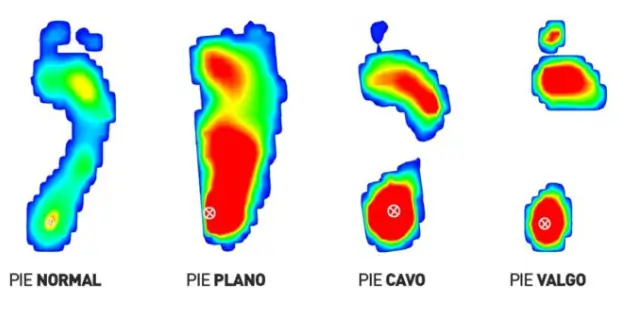 podograma, huella plantar